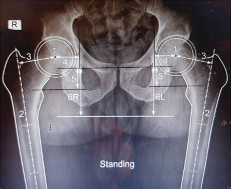 Preoperative Planning for Primary Total Hip Arthroplasty.